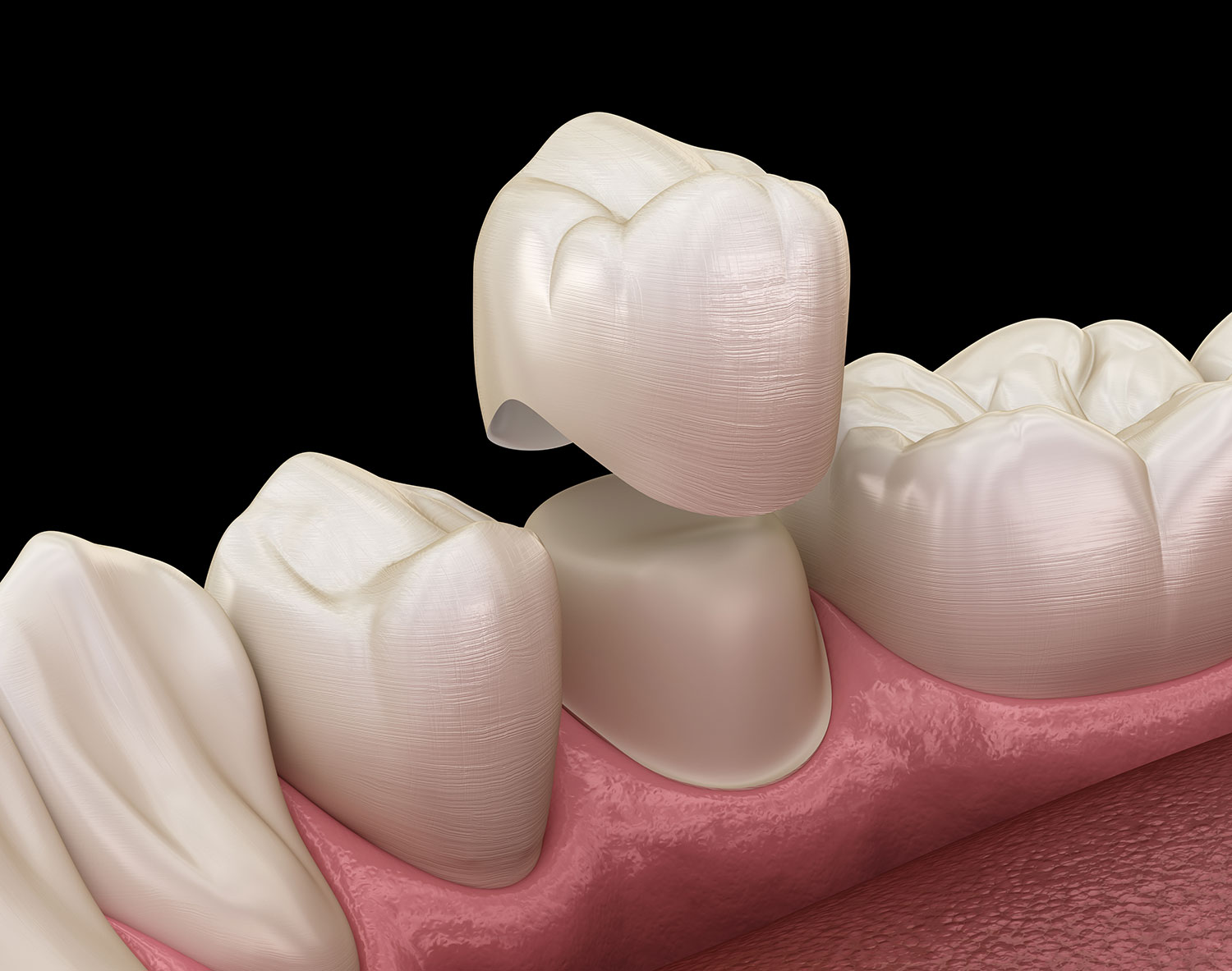 https://www.expressionsdental.co.uk/wp-content/uploads/2022/09/crowns.jpg