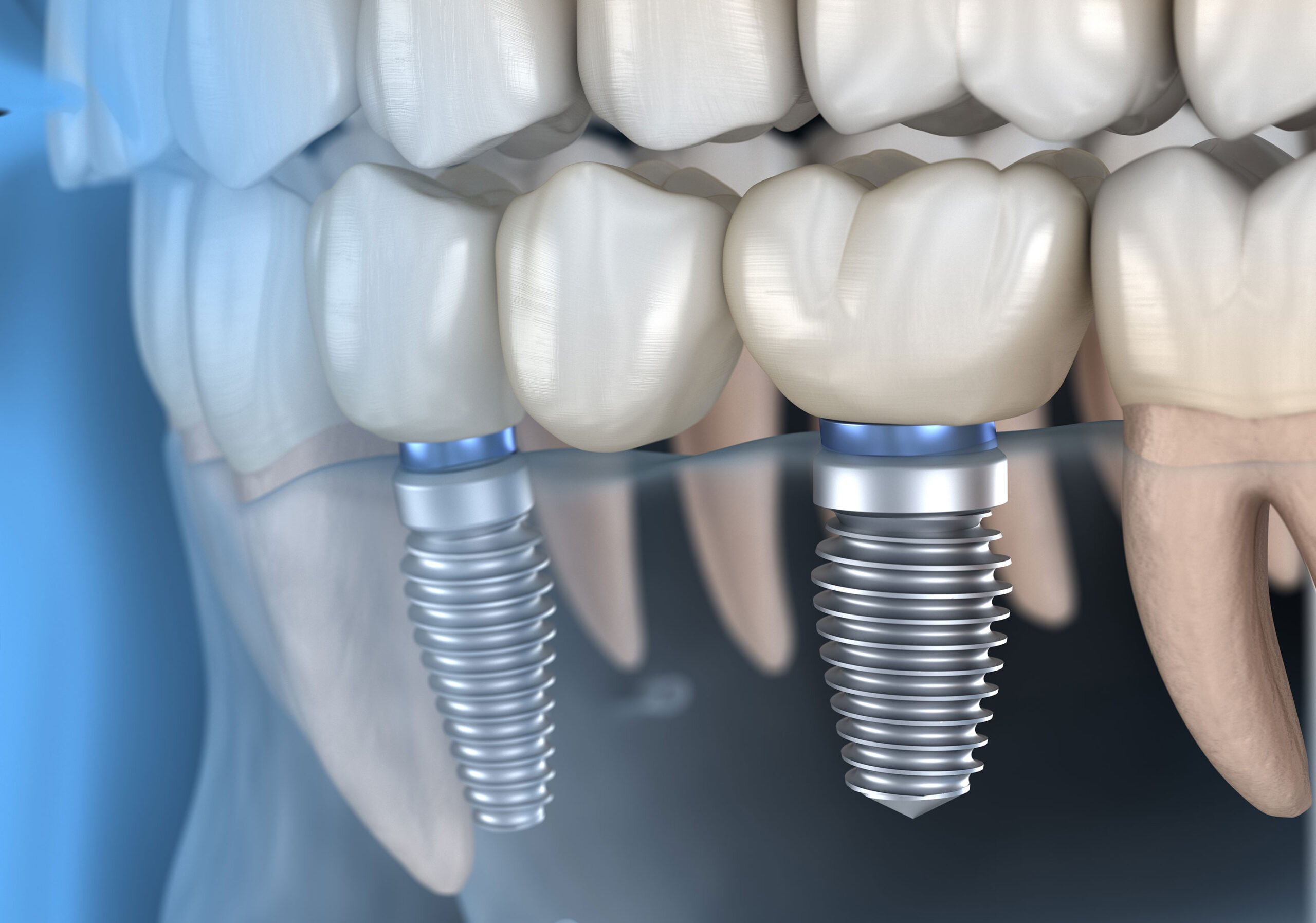 https://www.expressionsdental.co.uk/wp-content/uploads/2022/09/dental-implants-scaled.jpg