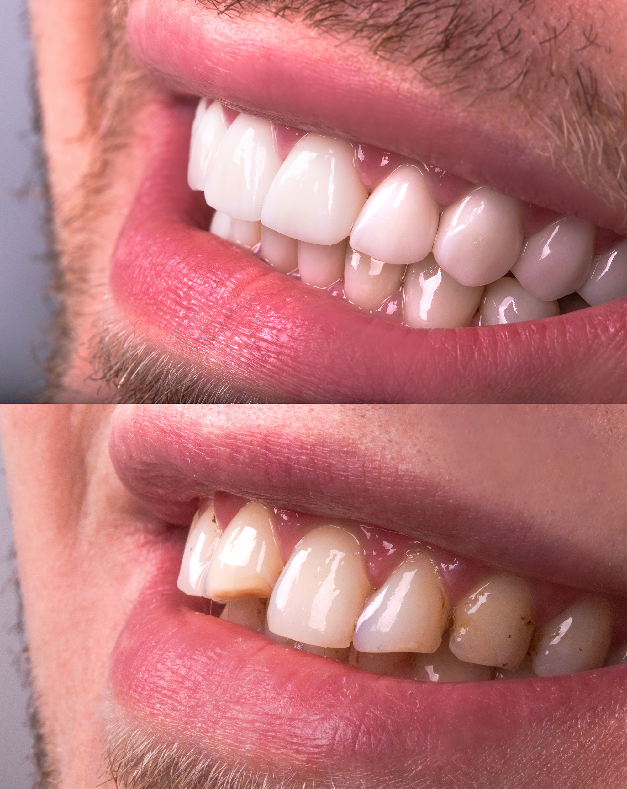 https://www.expressionsdental.co.uk/wp-content/uploads/2022/09/veneers.jpg