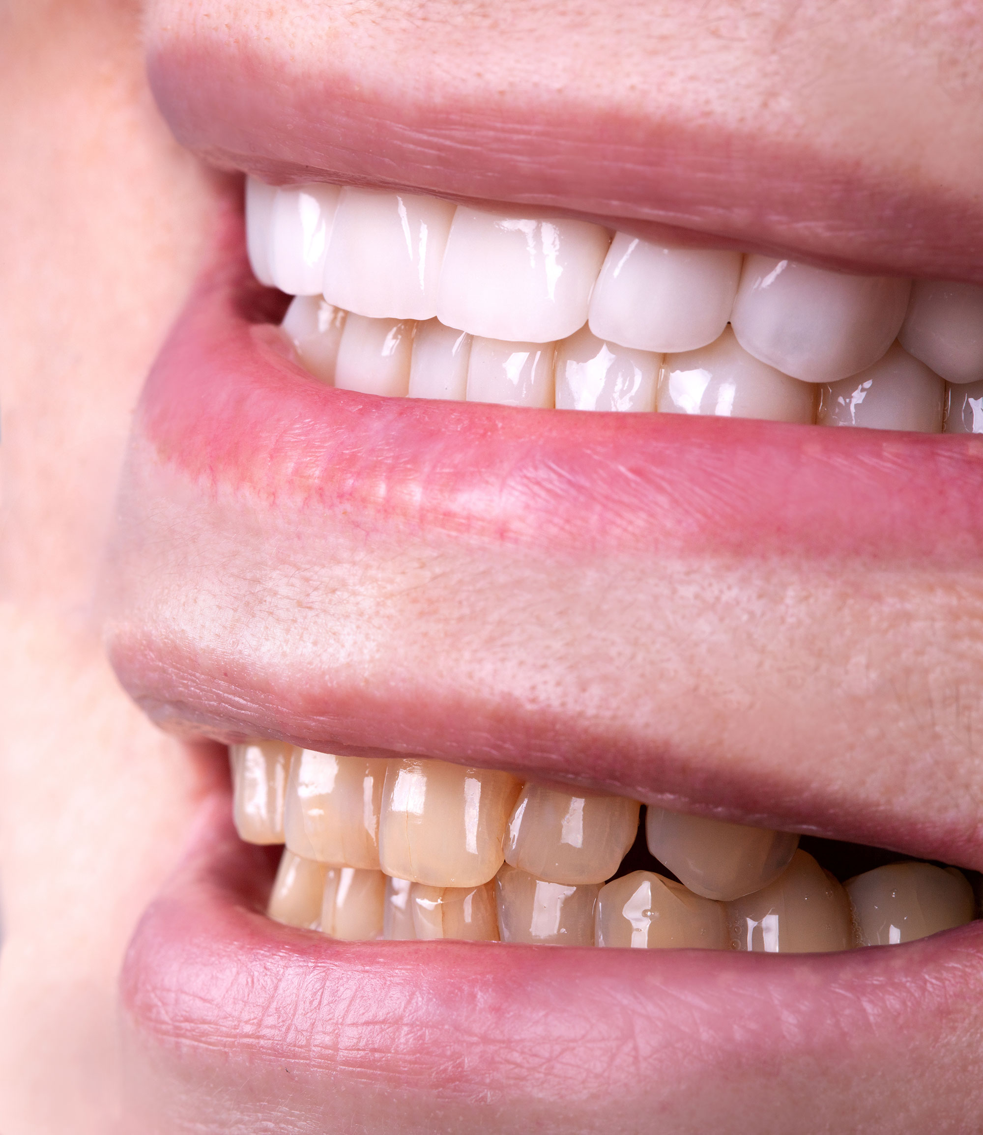 https://www.expressionsdental.co.uk/wp-content/uploads/2022/09/veneers2.jpg