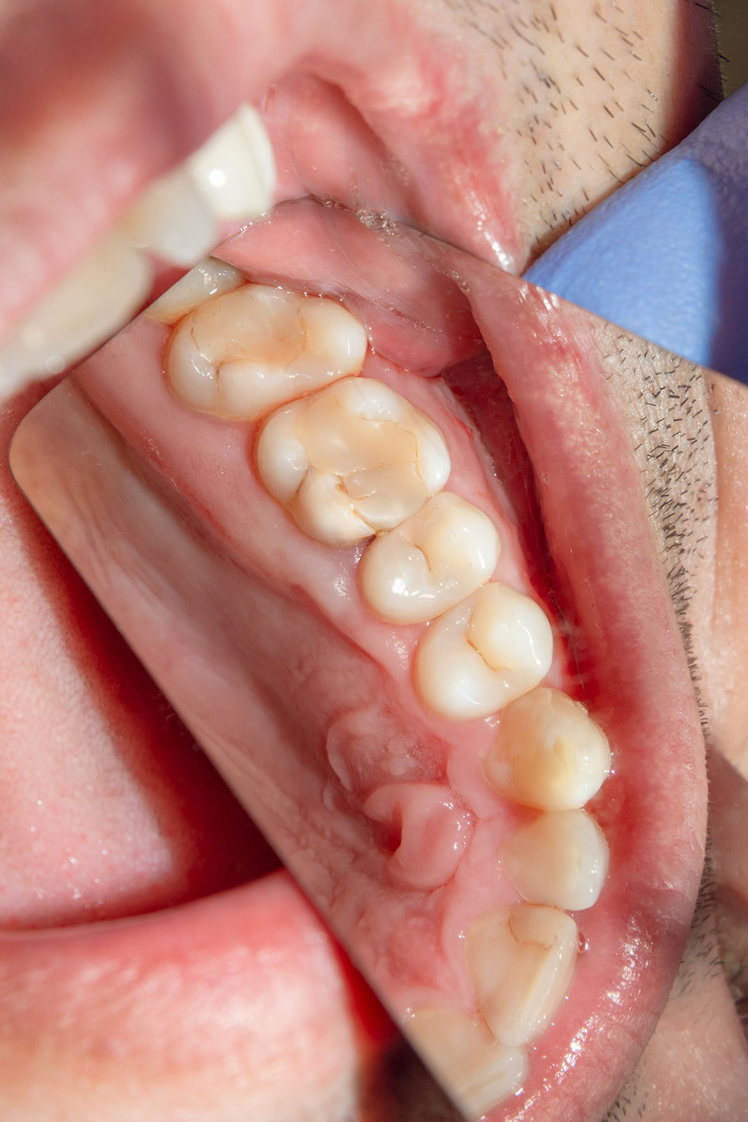 https://www.expressionsdental.co.uk/wp-content/uploads/2022/09/white-fillings.jpg